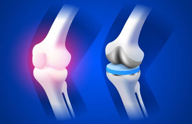Image of Bones of the knee