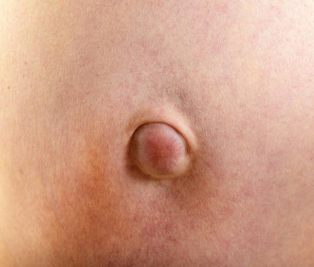 Image of a stomach with umbilical hernia