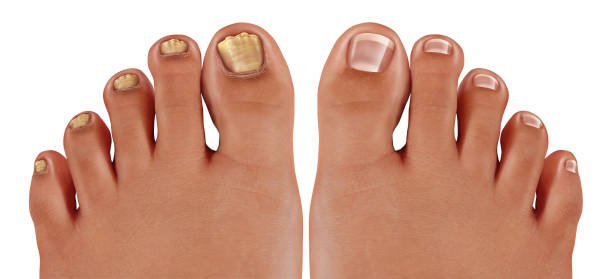 Image of a feet with 1 foot's toe nails being yellow and the other toe's white