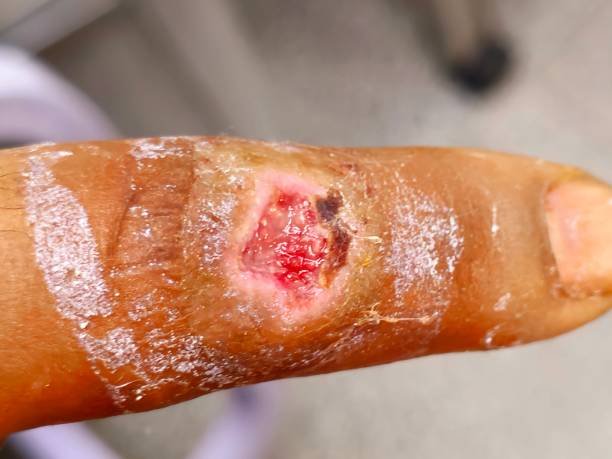 Image of a infected wound finger