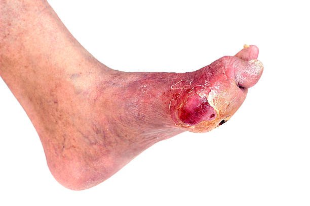 Diabetic wound on the feet