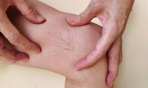 Is Laser Treatment For Varicose Veins Safe