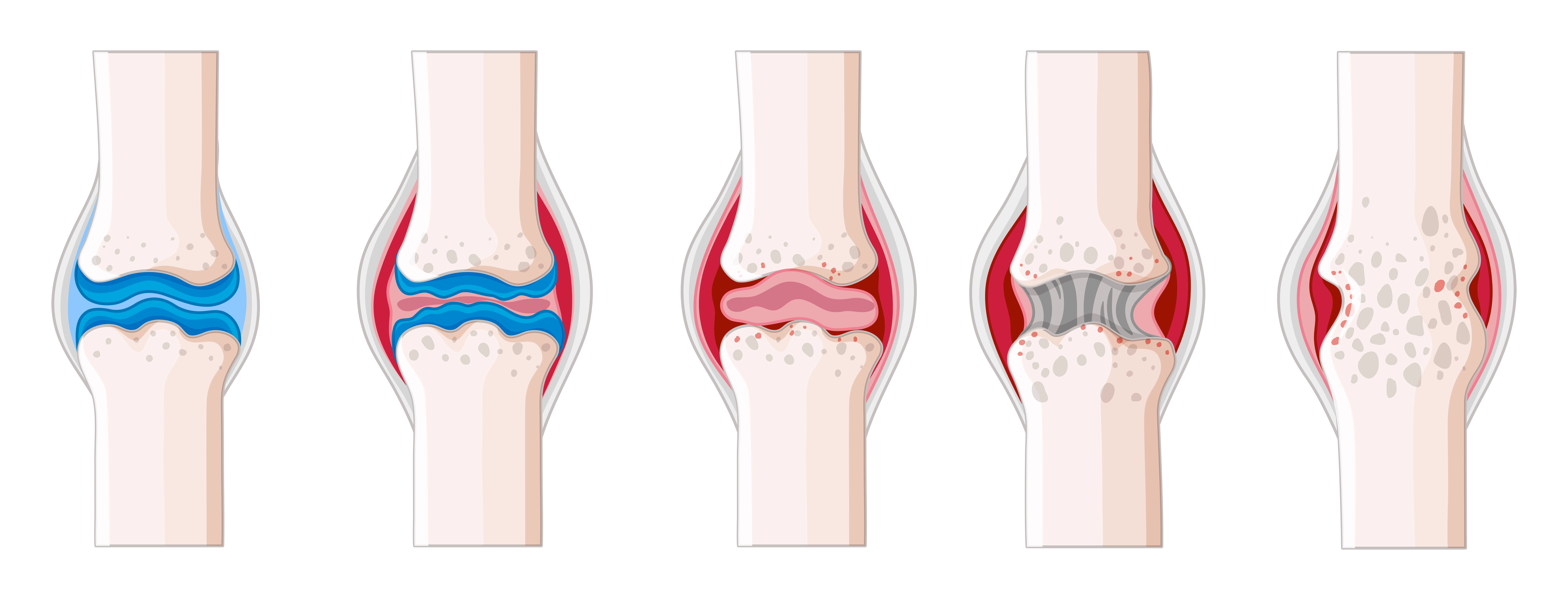 Knee Replacement Procedure Steps