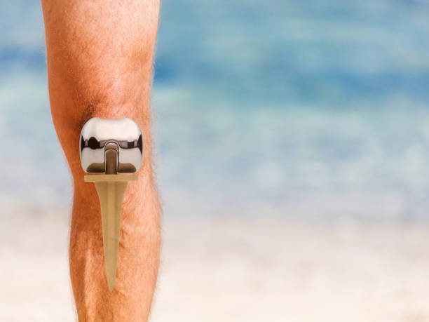 Image of a knee with a replacement done