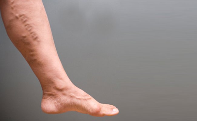 Varicose Veins Range of Severity Highlights Importance of Seeking