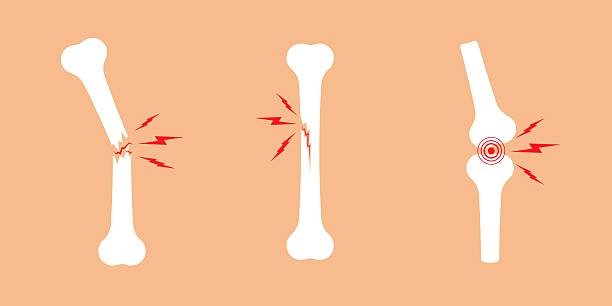 Image of a bone in different forms