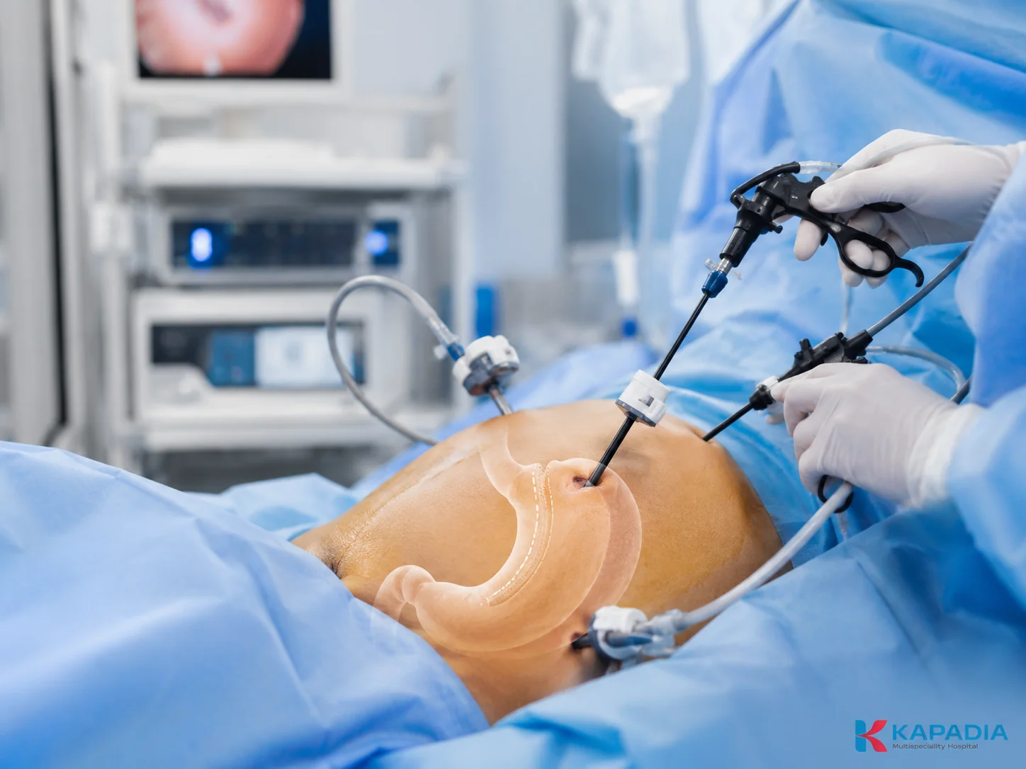Surgical team performing minimally invasive laparoscopic bariatric surgery in the operating theatre at Kapadia Hospital, Mumbai