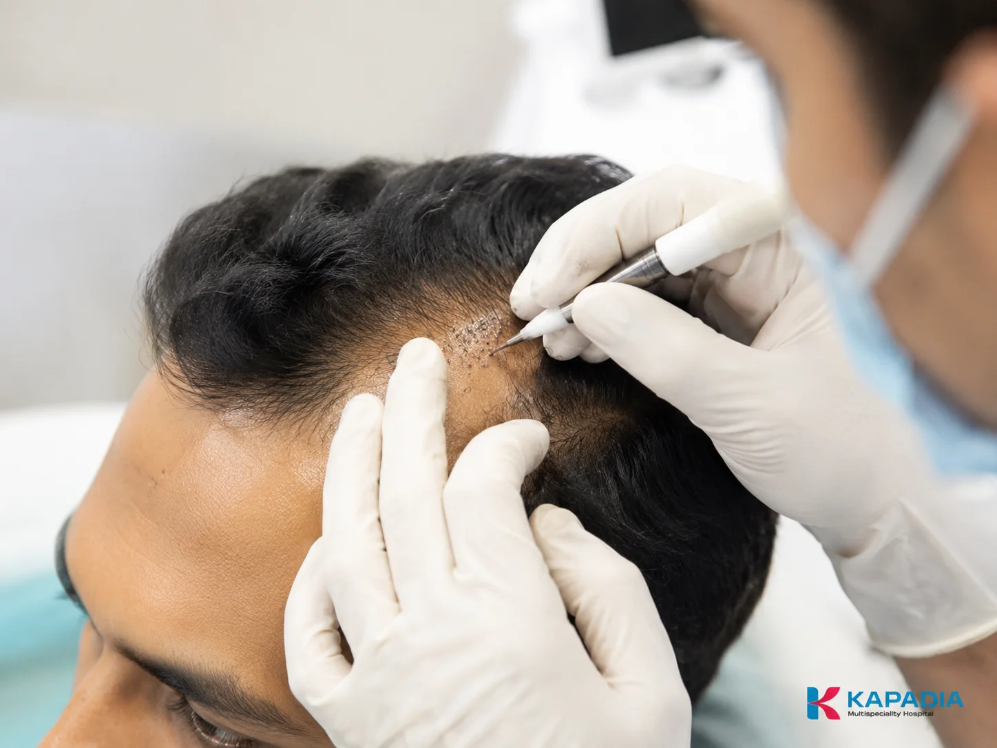 Gloved clinician working on the scalp during a hair transplant procedure at Kapadia Hospital, Mumbai
