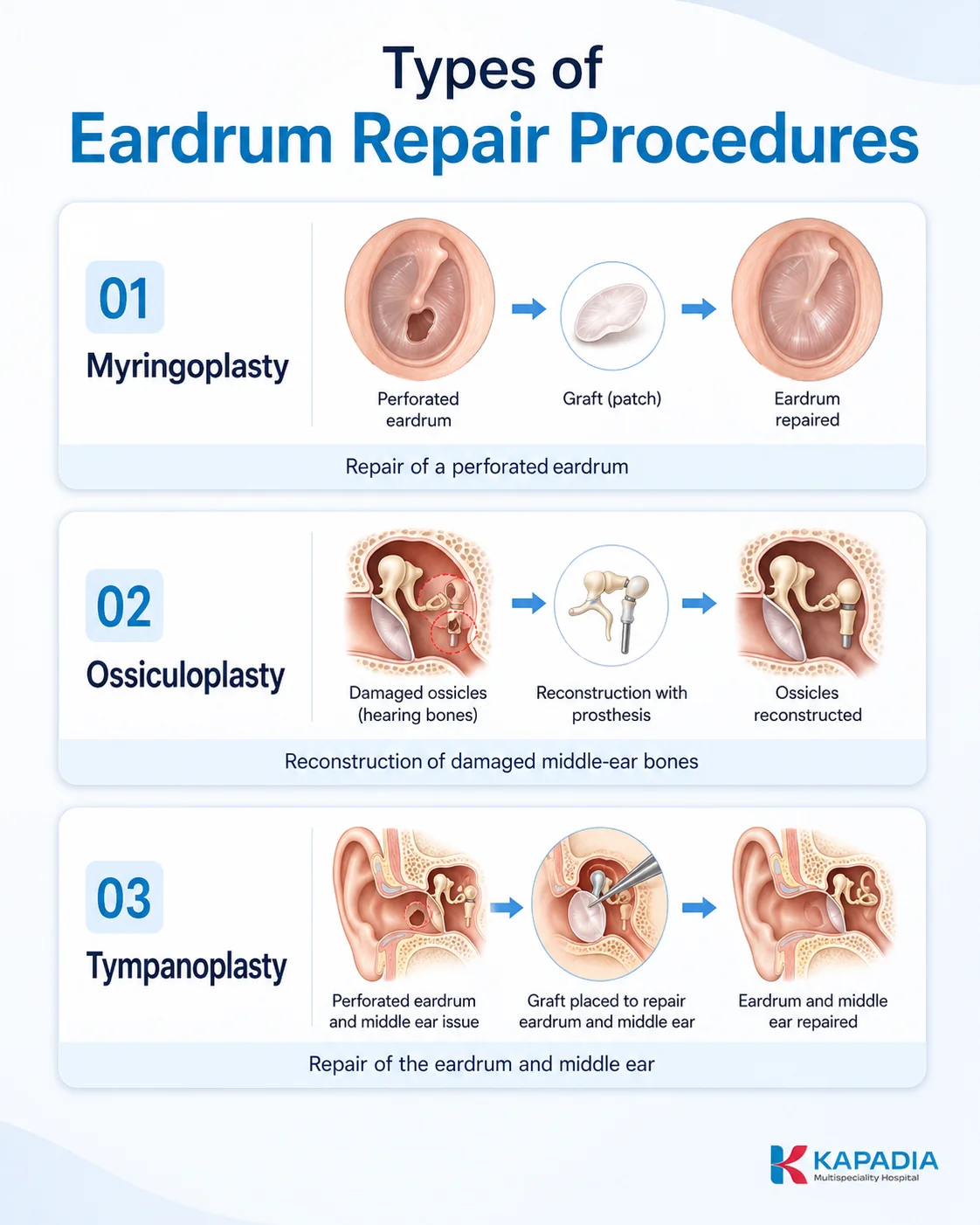 Eardrum repair procedures offered at Kapadia Multispeciality Hospital, Mumbai