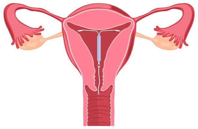 Copper-T intrauterine device used for long-term birth control at Kapadia Hospital, Mumbai
