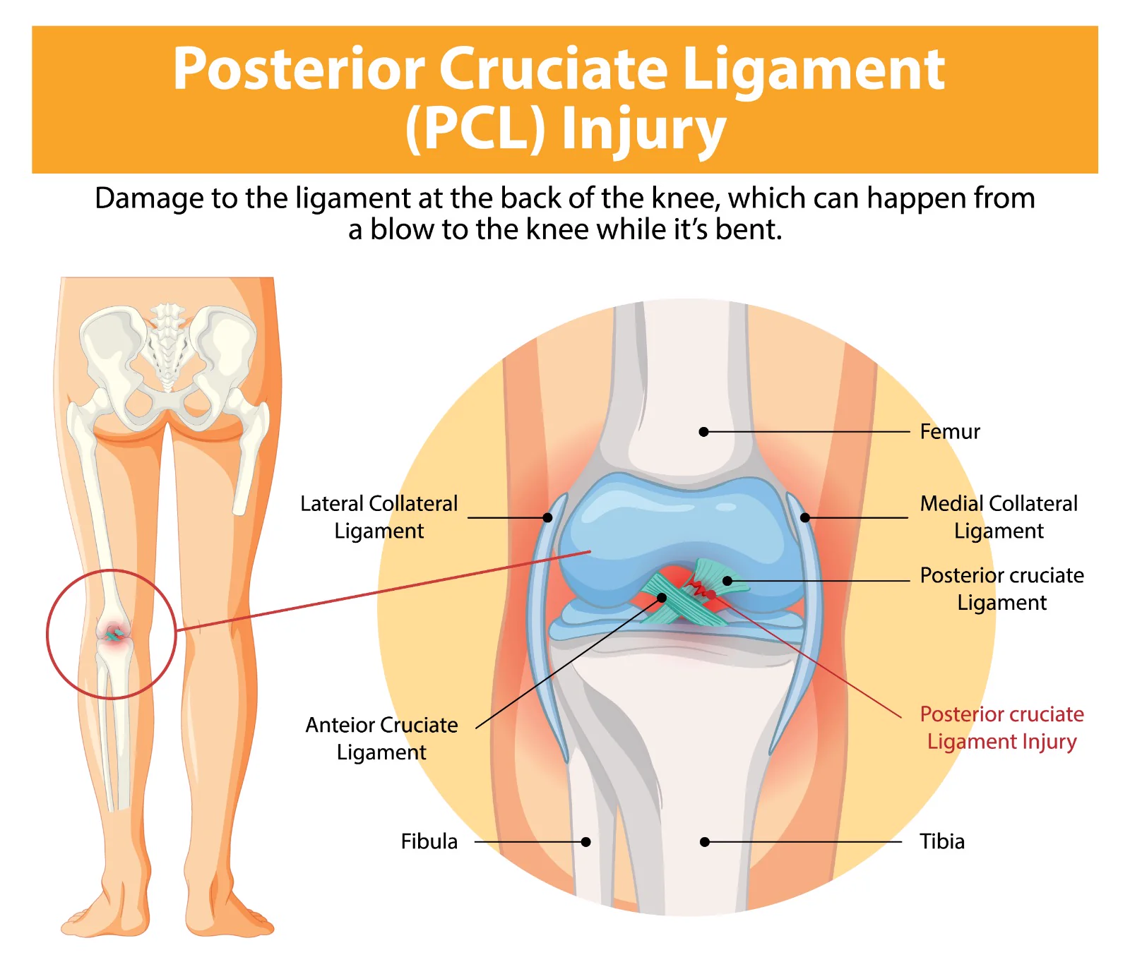 Knee support brace used during ACL and PCL rehabilitation at Kapadia Hospital, Mumbai