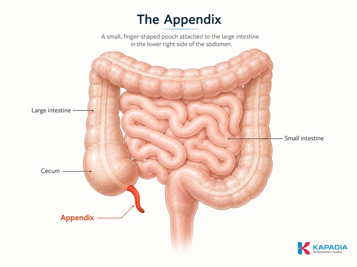 Labelled diagram of the appendix - a small finger-shaped pouch attached to the cecum where the small intestine meets the large intestine - Kapadia Hospital, Mumbai