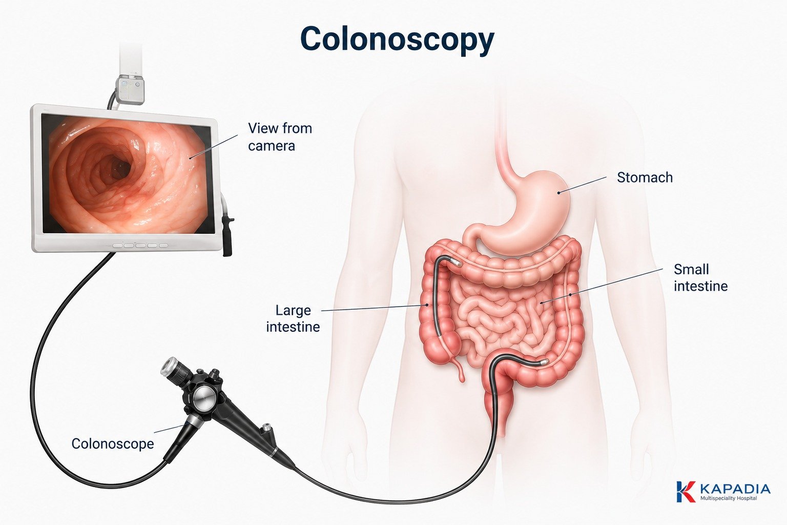 Labelled diagram of a colonoscopy - the colonoscope passed through the large intestine with the camera view shown on the monitor, alongside the stomach and small intestine - Kapadia Hospital, Mumbai