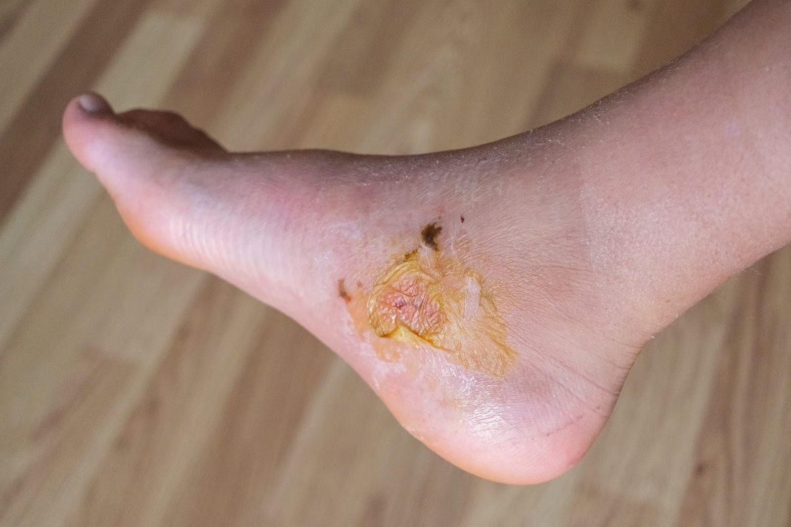 Non-healing diabetic ulcer on the side of a patient's foot, a warning sign needing specialist wound care - Kapadia Hospital, Mumbai