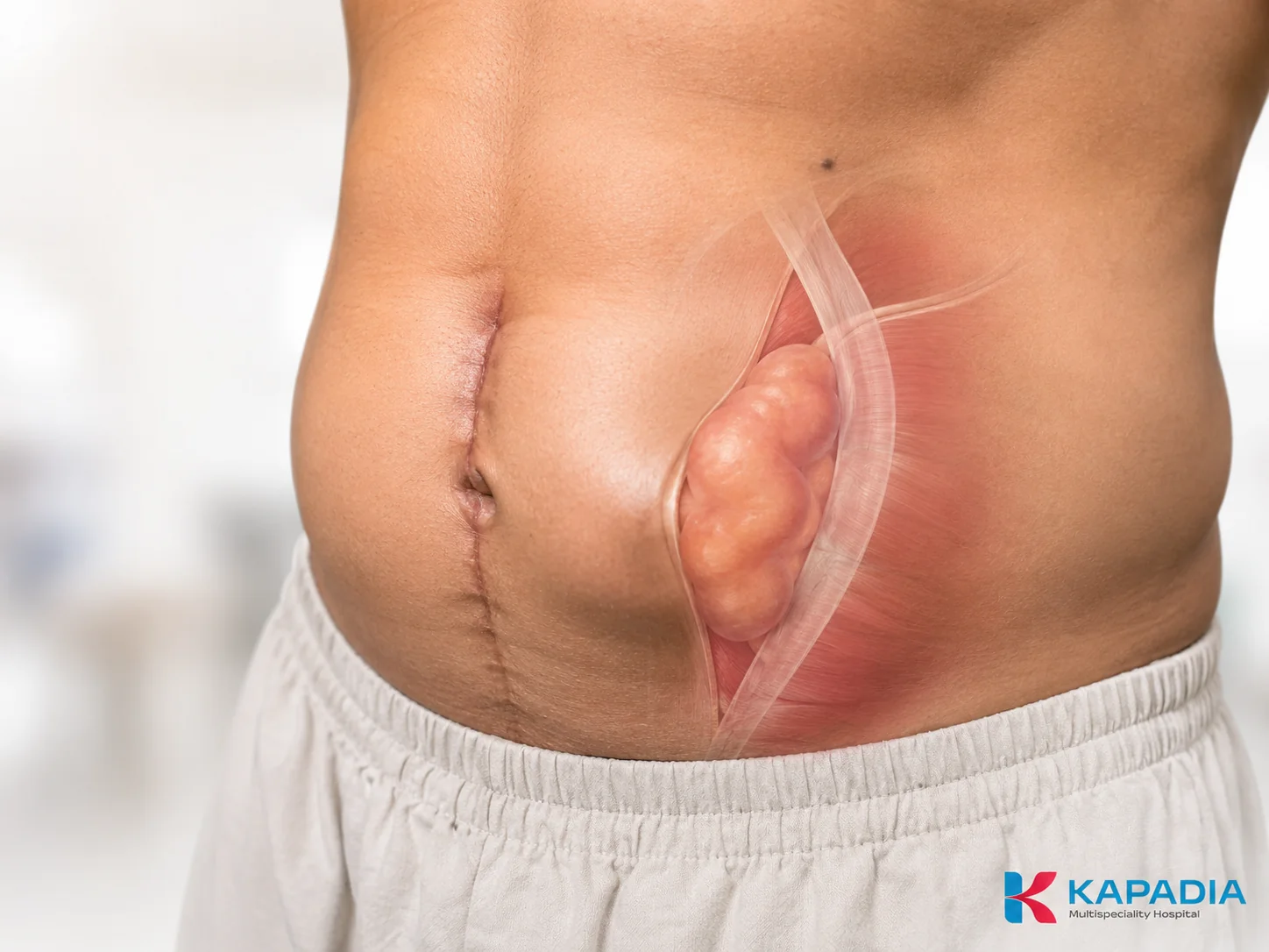 Repair of an incisional hernia at a previous surgical scar, Kapadia Hospital, Mumbai