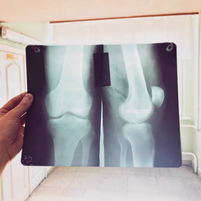 Joint replacement surgery in the operating theatre at Kapadia Hospital, Mumbai