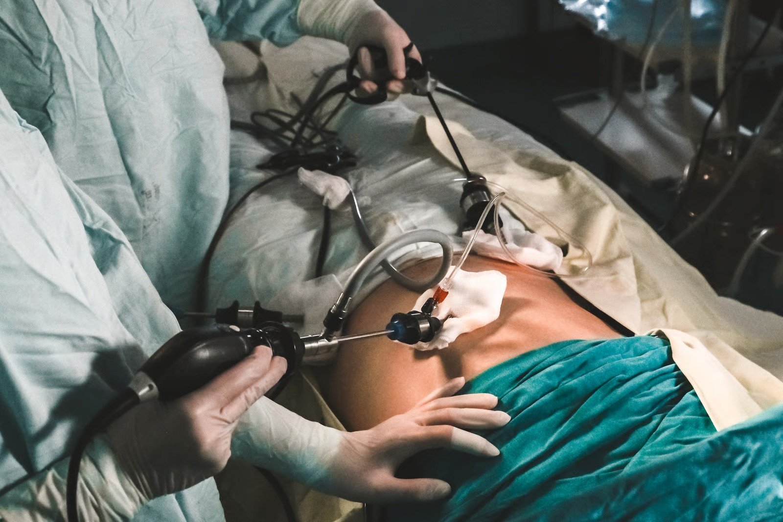 Surgical team performing keyhole hernia repair through laparoscopic ports in the operating theatre at Kapadia Hospital, Mumbai