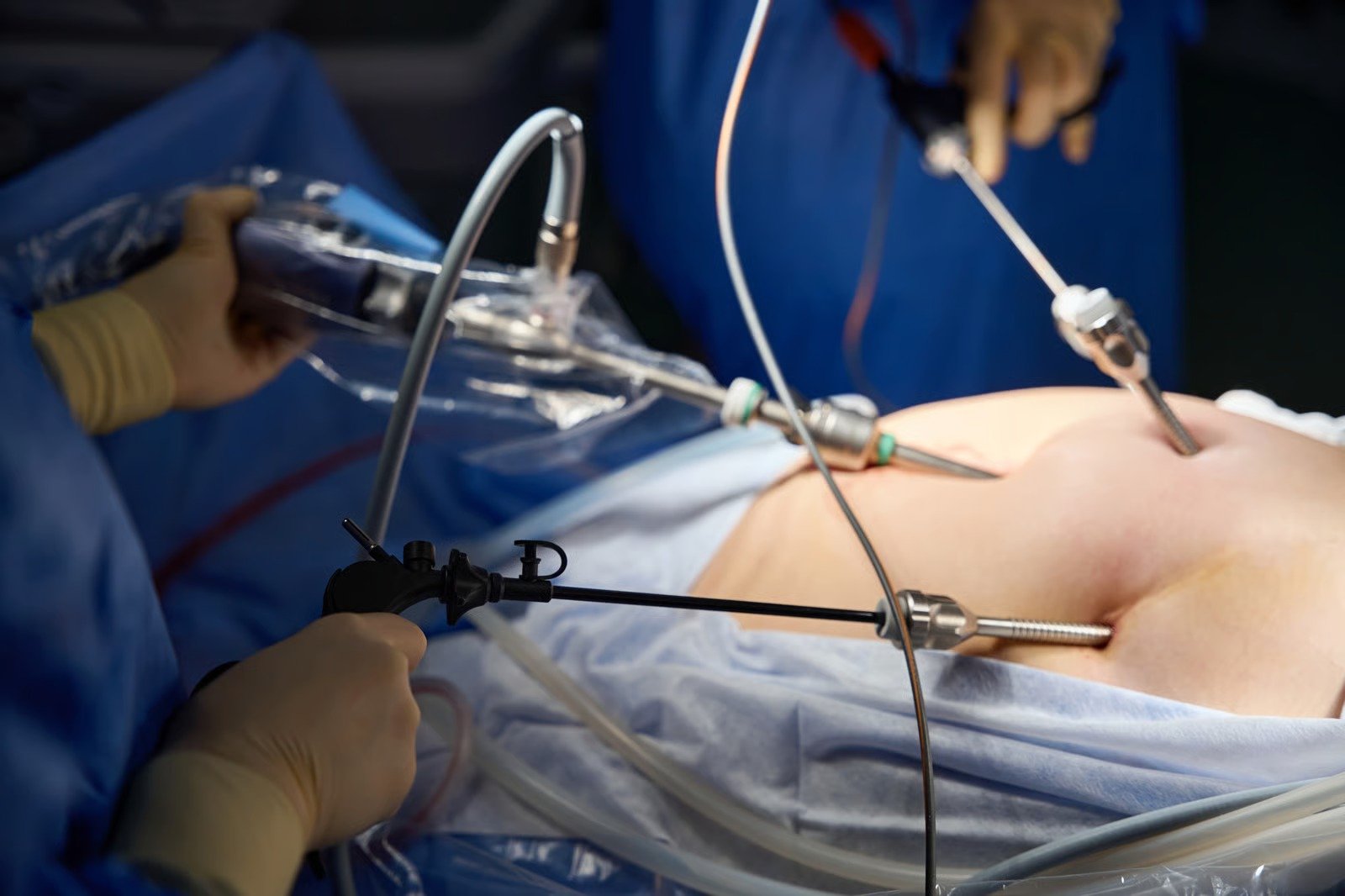 Surgeons operating through laparoscopic ports placed in the abdomen during keyhole hernia repair at Kapadia Hospital, Mumbai